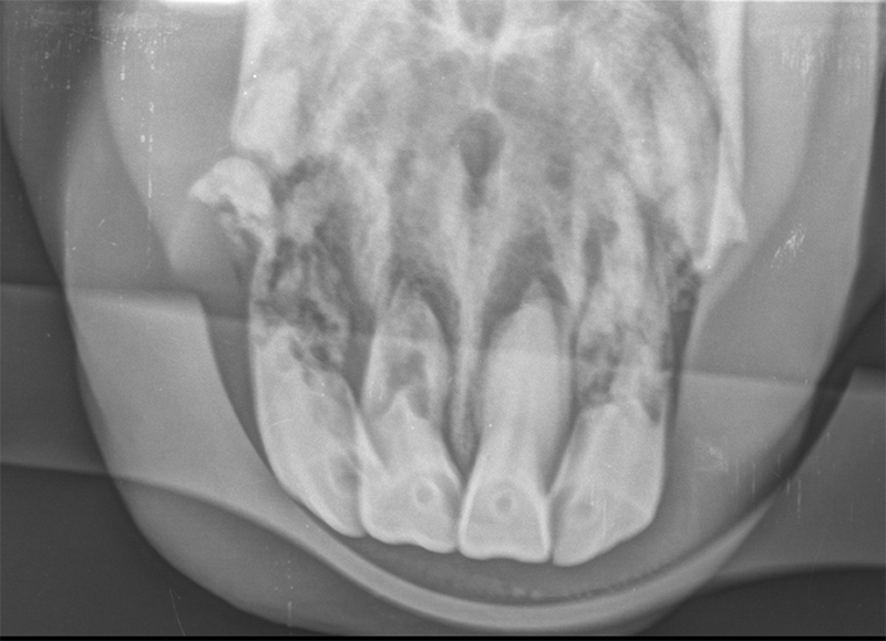 Fall 1: Röntgenbild Oberkieferschneidezähne: erweiterter Parodontalraum, auflösende Zahnsubstanz, frakturierte Schneidezähne