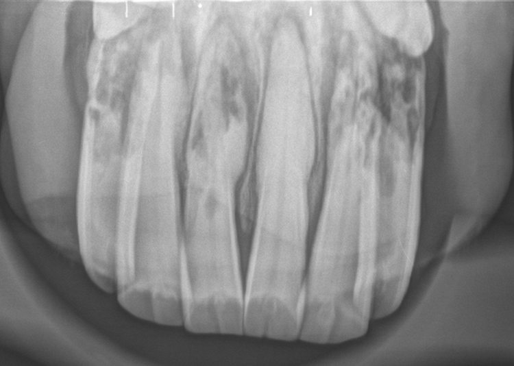 Fall 1: Röntgenbild Unterkieferschneidezähne